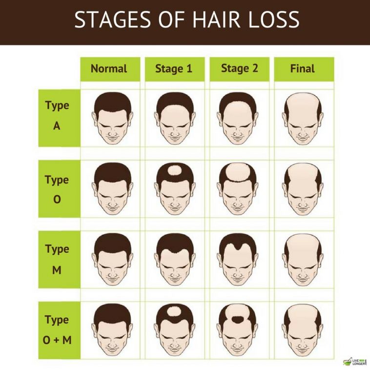 Stages Of Male Pattern Baldness 758x758 